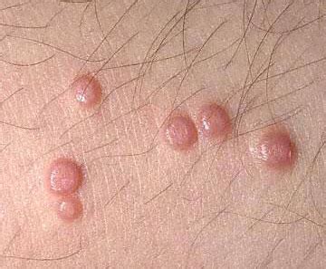 Bumps on Chest, Not Acne, Red, Itchy, White, Small, Under Skin, How to ...