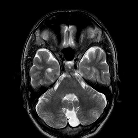 Mega Cisterna Magna Headache - Headache