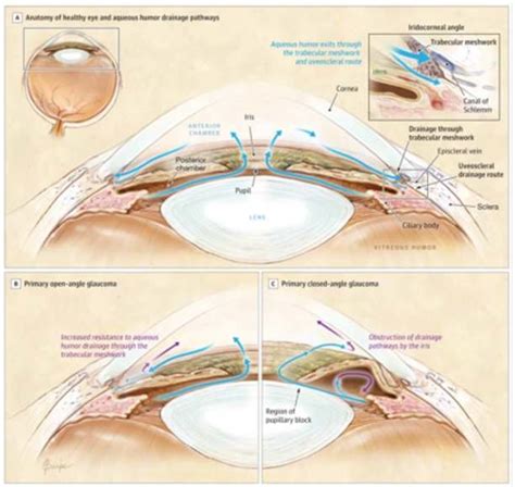 Showing aqueous drainage in normal and in cases of open angle and... | Download Scientific Diagram