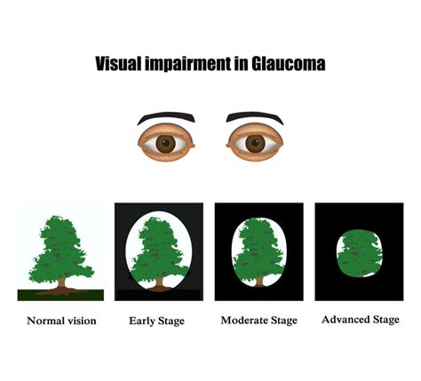 Glaucoma – Risk Factors, Symptoms & Treatment | Davis Eyecare