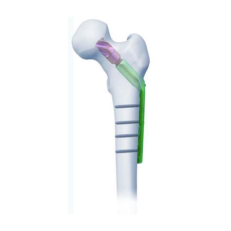 Dynamic Hip Screw System,Medical Device Manufacturers -Double Medical