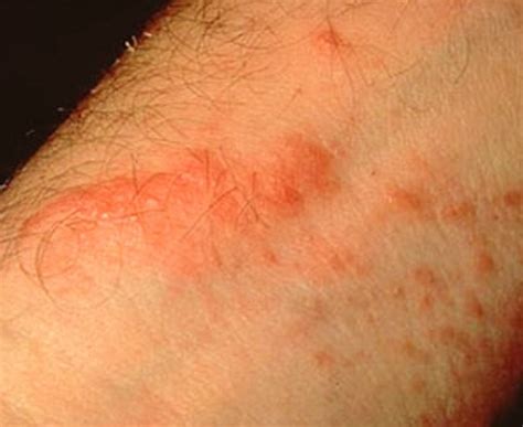 Poison Oak Rash | Good Health