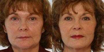 Lipodissolve Worth it? Reviews, Cost, Pictures - RealSelf