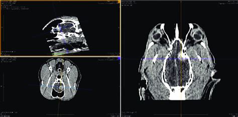 Left outer sphenoid wing meningioma. | Download Scientific Diagram