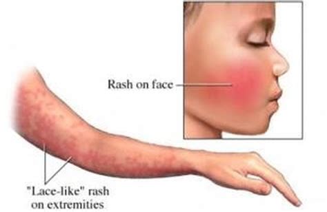 Fifth's Disease