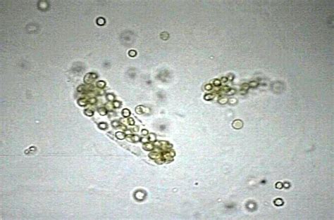 Red Blood Cells Casts in Renal Hematuria | Medical Laboratories