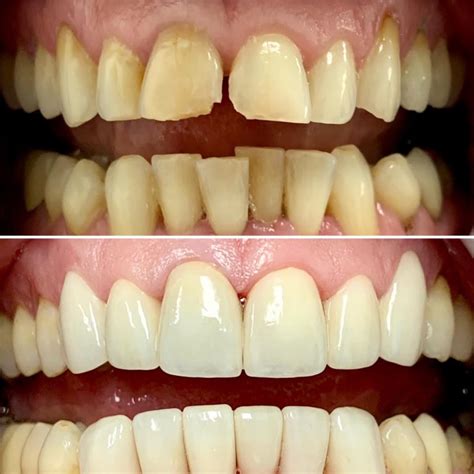 chipped teeth-before/after | Dr. Gentry