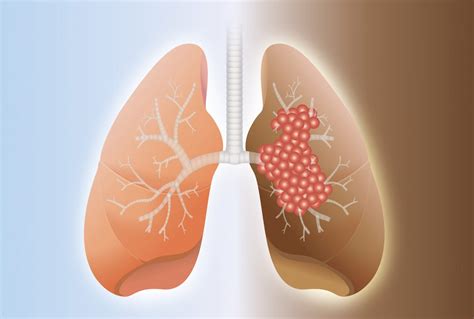 FAQs About Pulmonary Fibrosis – Pulmonary Fibrosis News