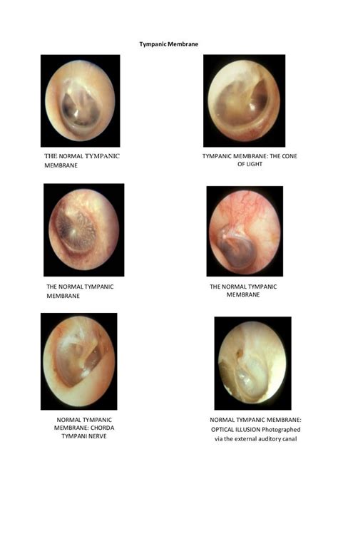 Tympanic membrane dr. fadil