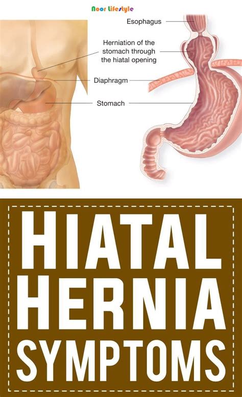 Pin on Diet for a Hiatal Hernia