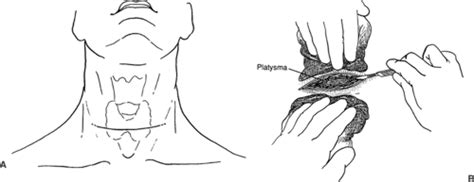 Thyroid Lobectomy | Basicmedical Key