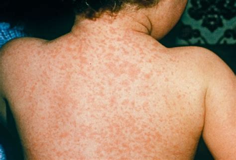 Measles Rash – Symptoms, Causes, Treatment