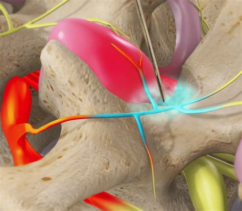 Medial Branch Block | Neck, Shoulder, and Arm Pain