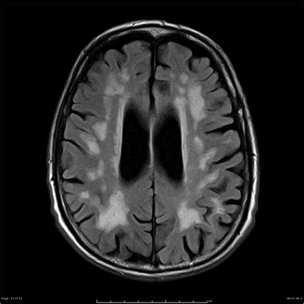 Moderate Chronic Small Vessel Ischemic Disease - Pregnancy Informations