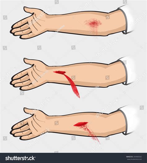 Bleeding Types Bleeding Classification Classification Bleeding: Stockillustration 264960542 ...