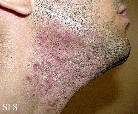 Pseudofolliculitis barbae - wikidoc