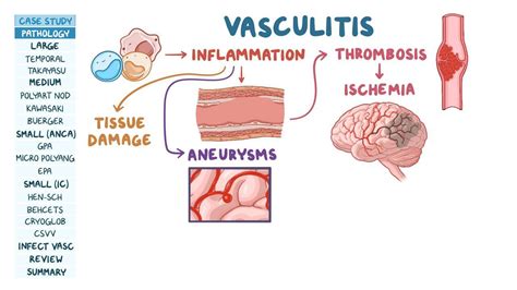 Vasculitis Chart