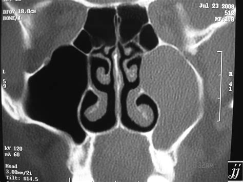 ENT- maxillary sinus retention cyst - Radioogle