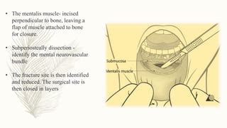 Mandibular Fracture.ppt