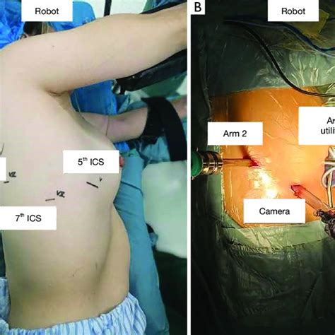 Position of the utility incision and ports for a right-sided lobectomy.... | Download Scientific ...