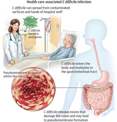 Clostridium difficile Infection | Patient Information | JAMA | JAMA Network