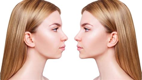 What You Need To Know About Jaw Contouring Surgery