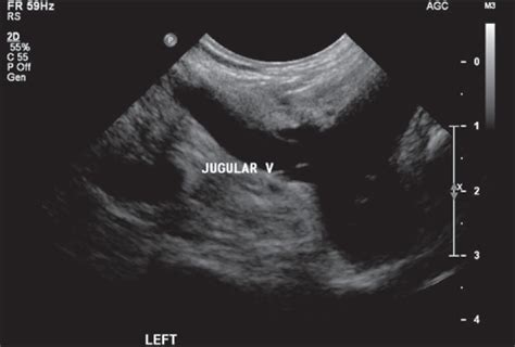 Picc In Innominate Vein