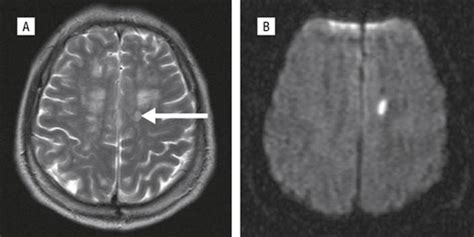 Ipsilateral Hemiparesis Caused by a Corona Radiata Infarct After a Previous Stroke on the ...