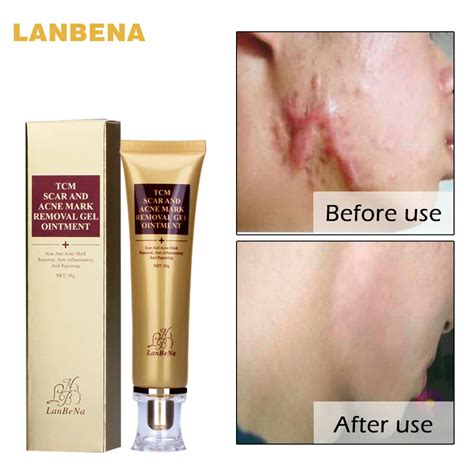 Best LANBENA Acne Scar Removal Cream Skin Repair Face Cream Acne Spots ...