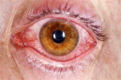 Conjunctivitis – Jiggins Lane Medical Centre