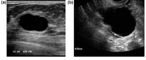 Cyst Vs Tumor Ultrasound