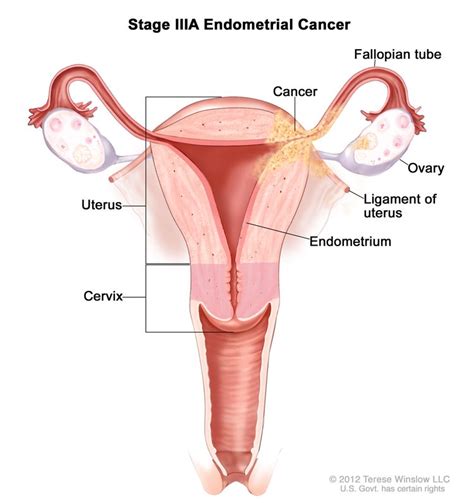 Endometrial Cancer Treatment - NCI