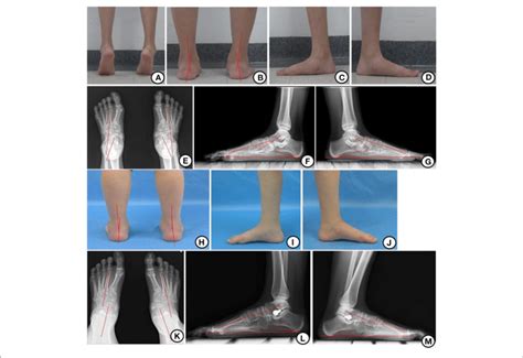 | Appearance and x-ray before and after operation. (A) Hindfoot valgus ...