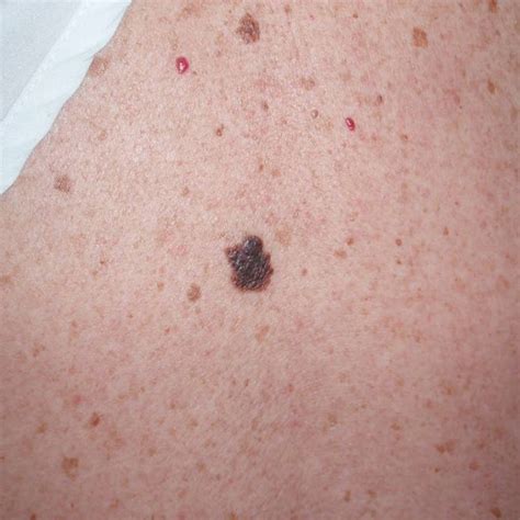 Cancer De Melanoma