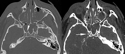 Sphenoid Fracture