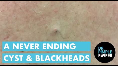 A Never Ending Cyst and Blackheads - YouTube