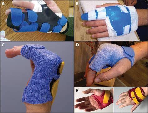 Radial Gutter Splint Pattern