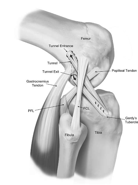 Lemaire technique. 27 (FCL, fibular collateral ligament; PFL,... | Download Scientific Diagram