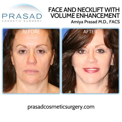 How to Choose the Best Neck Lift Procedure | Dr. Prasad Blog