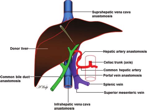 Liver Transplant Diagram