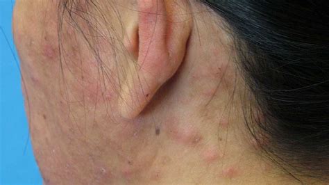 Itchy Red Rash On Scalp And Neck | Allergy Trigger