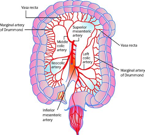 Ischaemic colitis | The BMJ