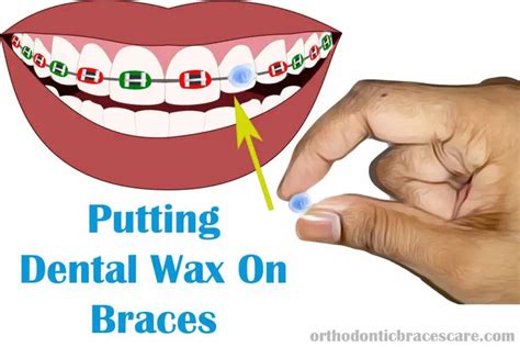 How To Apply Dental Wax On Braces [Step-By-Step Guide] - Orthodontic ...