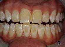 Dental fluorosis - Wikipedia