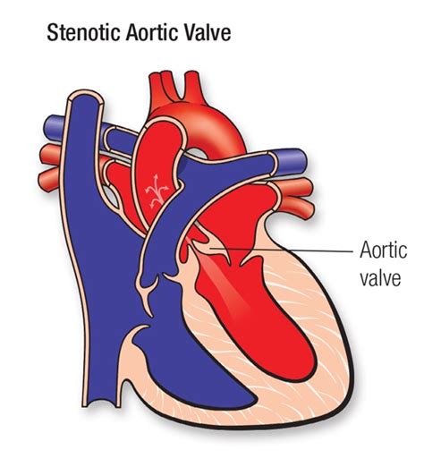 Aortic Stenosis