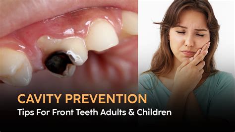 Cavity Prevention Tips for Front Teeth in Adults & Children | Blog