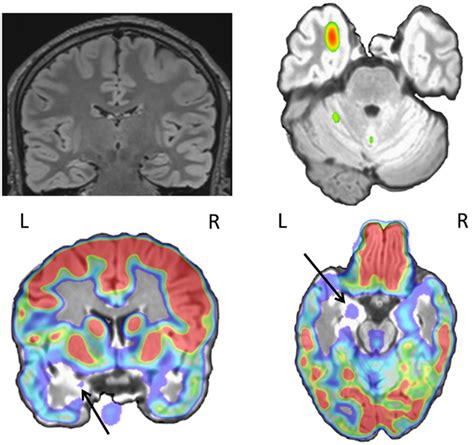 Twenty-seven-year-old patient with left mesial temporal lobe sclerosis... | Download Scientific ...