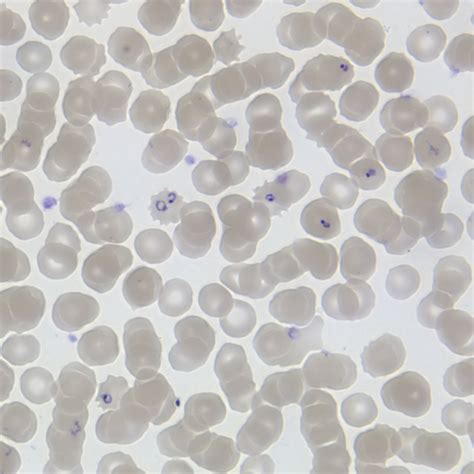 File:Plasmodium falciparum (malaria) parasite in blood.jpg - Wikimedia Commons