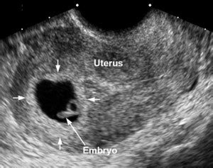 Amniotic Sac - Preg Med