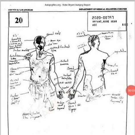 Kobe Autopsy – Kobe Bryant Autopsy Report Sketch Surface Online